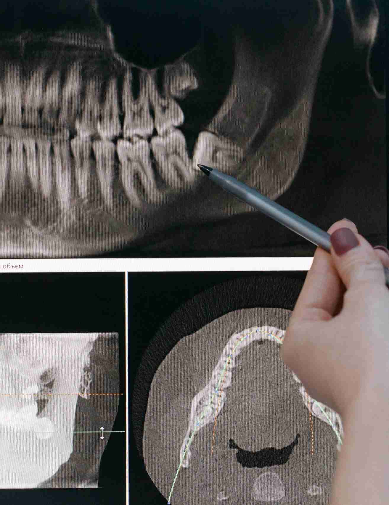 Detailed shot of a dentist applying veneer to a woman's teeth during a dental procedure.