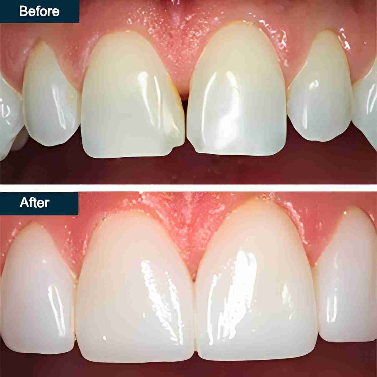 Detailed shot of a dentist applying veneer to a woman's teeth during a dental procedure.