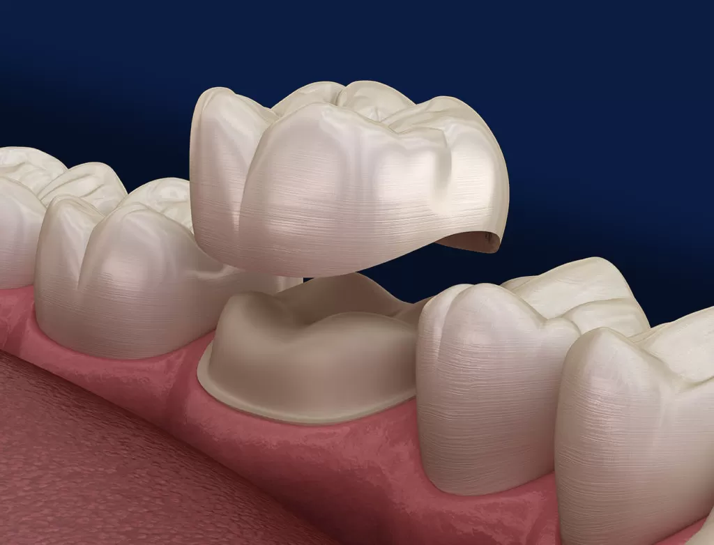 Detailed shot of a dentist applying veneer to a woman's teeth during a dental procedure.