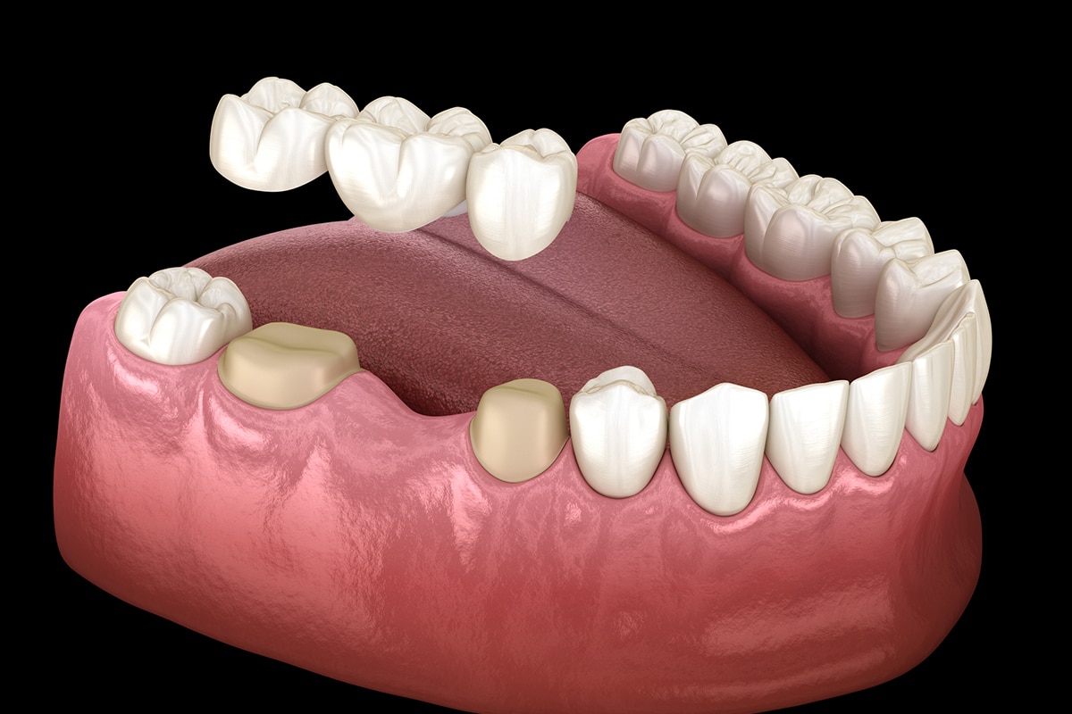 Detailed shot of a dentist applying veneer to a woman's teeth during a dental procedure.