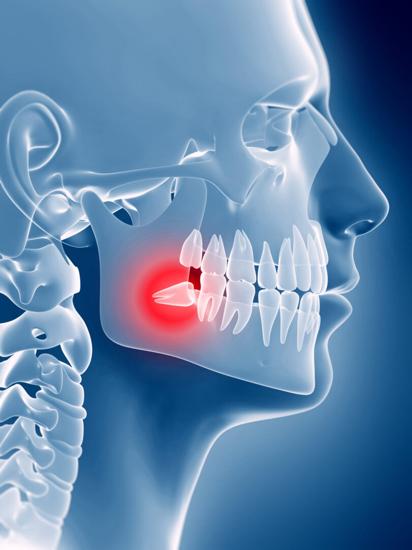 Detailed shot of a dentist applying veneer to a woman's teeth during a dental procedure.
