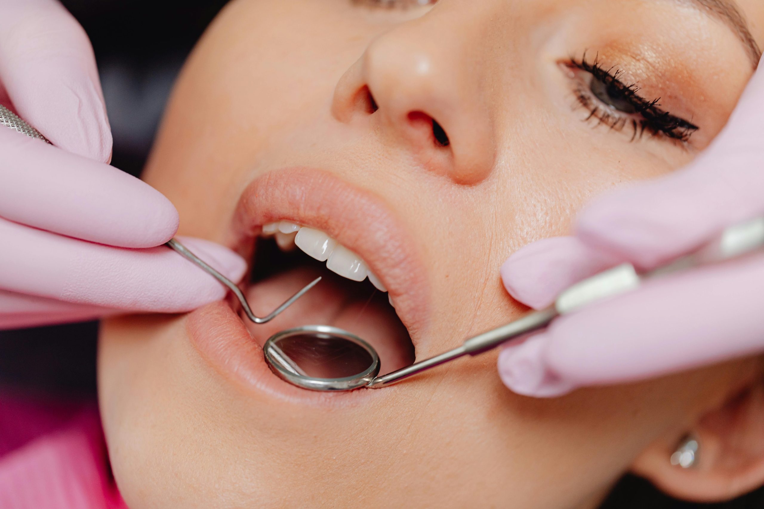 Detailed shot of a dentist applying veneer to a woman's teeth during a dental procedure.